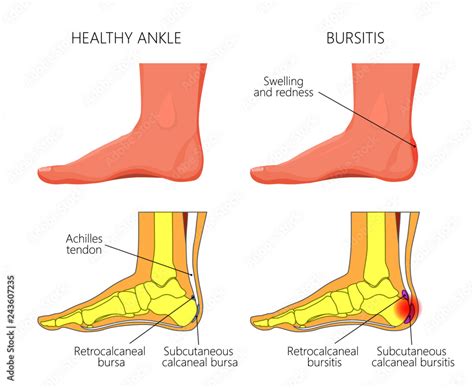 Subcutaneous Calcaneal Bursitis