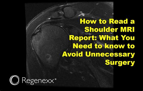 How to Read a Normal vs. Abnormal Shoulder MRI - Regenexx