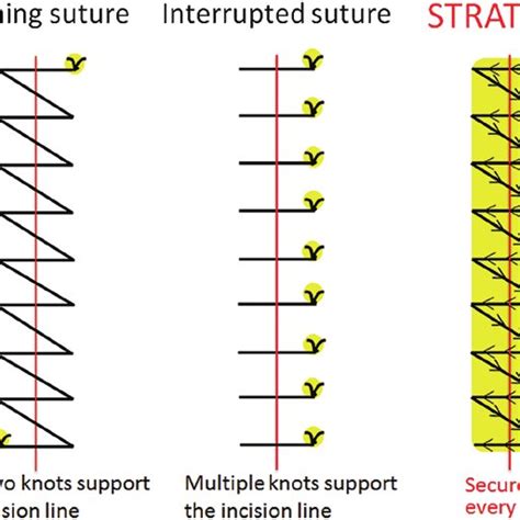 Conventional running sutures and interrupted sutures as compared with ...