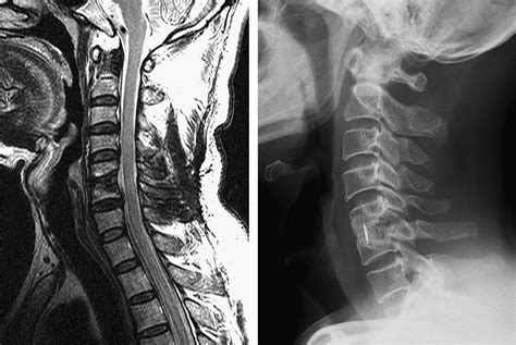 Spontaneous resolution of tetraparesis because of postoperative ...