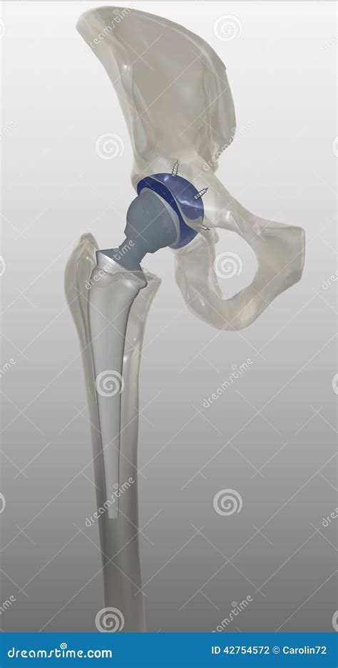 Artificial hip stock illustration. Illustration of medical - 42754572