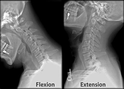 C-spine X-ray : Mnemonic Approach | Epomedicine