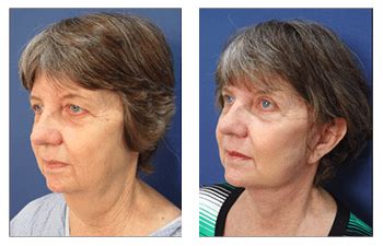 Facelift postoperative recovery | Our Surgical Team