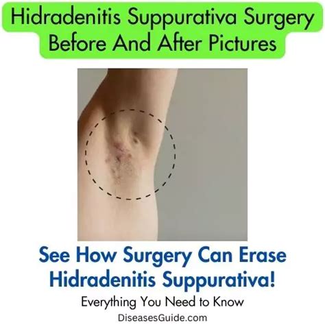 hidradenitis suppurativa surgery before and after pictures - Diseases Guide