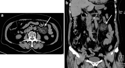 CT scan upon admission revealed mesenteric edema below the left kidney... | Download Scientific ...