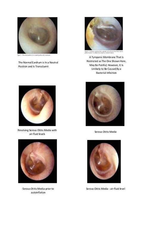 Tympanic Membrane Fungal Infection