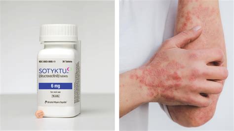 Sotyktu (deucravacitinib) Gets FDA Approval for Moderate-to-Severe Plaque Psoriasis - Xtalks