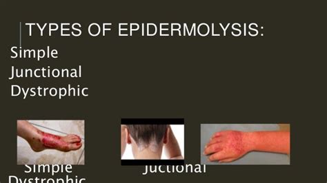 Epidermolysis bullosa