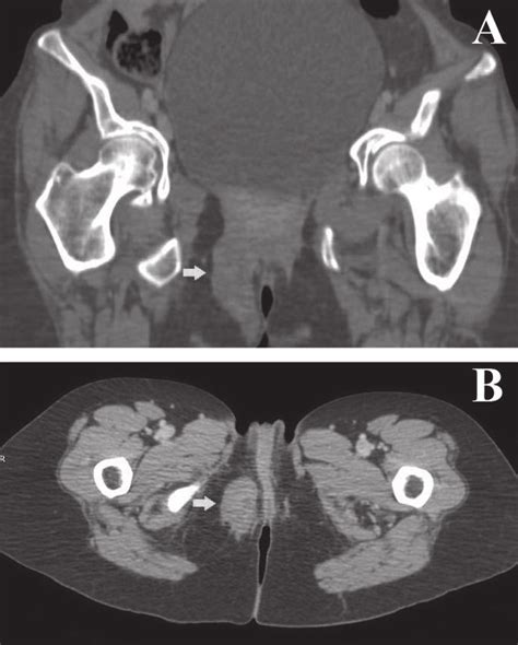 (A) Coronal CT scan. (B) Axial CT scan. Both images show the tumor in... | Download Scientific ...