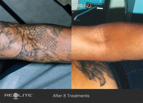 Tattoo Removal | Dermatology and Laser Centre of Los Angeles