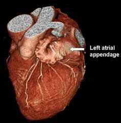 Left atrial appendage - Definition, Anatomy, Function and Pictures - Bodterms