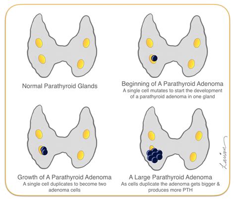 Parathyroid Adenoma Growth - Hyperparathyroidism Surgery - Dr. Babak Larian