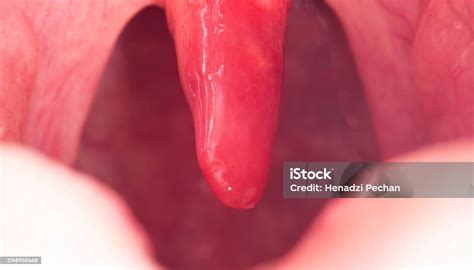 Red Inflamed And Swollen Uvula In The Throat Treatment Of Uvulitis Due To Bacteria And ...