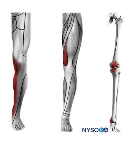 Saphenous nerve block at the adductor canal.