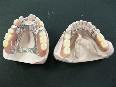 Cast Partial Dentures: All You Need To Know About Cast Partial Dentures