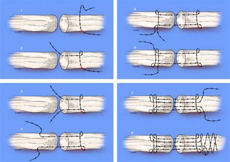 Flexor Tendon Repair With a Knotless Barbed Suture: A Comparative ...