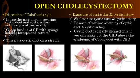 Open cholecystectomy/ operative surgery