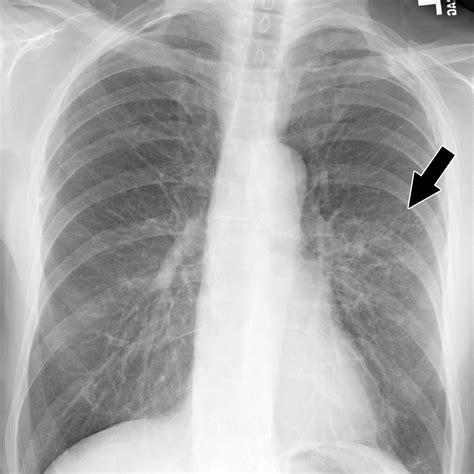 Bronchiolitis: A Practical Approach for the General Radiologist | RadioGraphics