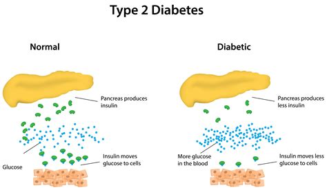 Type 2 Diabetes