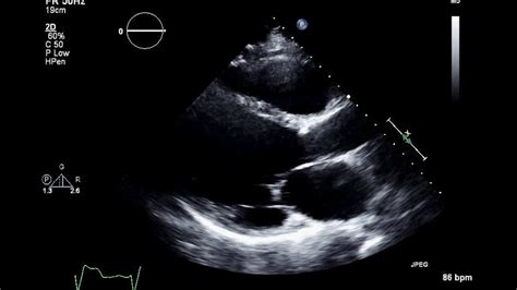 Echocardiogram Of Heart Failure