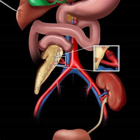 Pancreatic Transplantation | Radiology Key