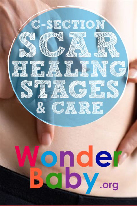 C-Section Scar Healing Stages and Care | WonderBaby.org