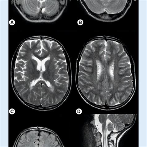 MRI in cystic leukodystrophy (fluid-attenuated inversion-recovery image). | Download Scientific ...