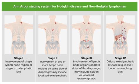 Non-Hodgkin Lymphoma | Medical Library