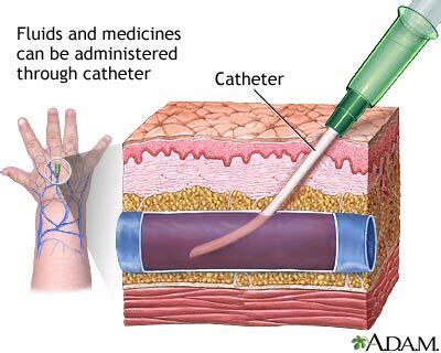 Peripheral intravenous line - infants - UF Health