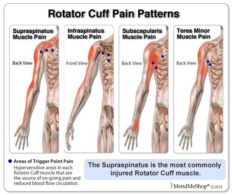 Rotator Cuff Treatments