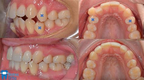 Comprehensive orthodontic treatment with extraction of 4️⃣ premolars