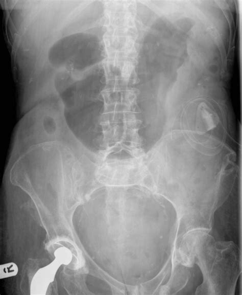 Gastric outlet obstruction | Radiology Key