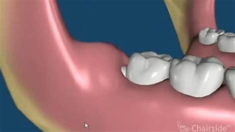 Impacted-Wisdom-Teeth-Removal-Animation_video – FLOSS Dental – Kingwood TX