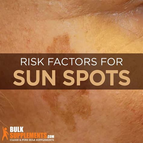 What are Sunspots: Symptoms, Causes & Treatment