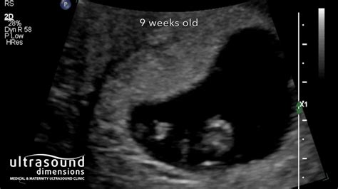 9 Weeks Pregnant 3d Ultrasound