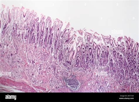 Histopathology of chronic atrophic gastritis, light micrograph, photo ...