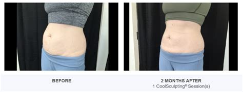 CoolSculpting - Reston Dermatology & Cosmetic Center