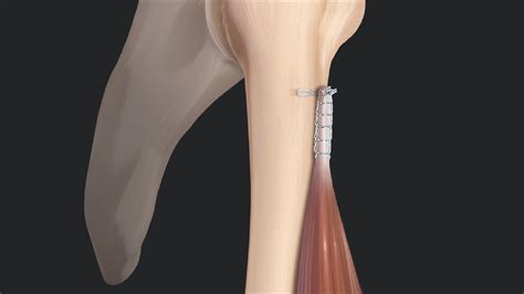 Arthrex - Biceps Tenotomy vs Tenodesis: Literature Review and Rationale ...