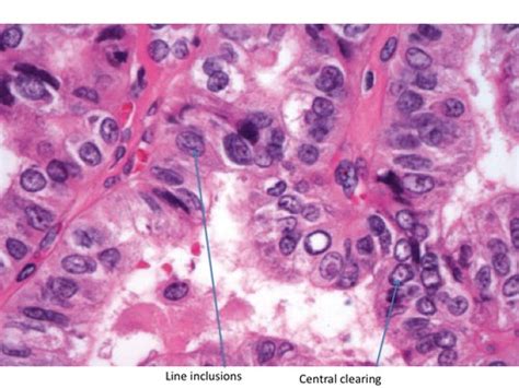 Thyroid Cancer Histology Flashcards | Quizlet