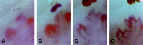 Clinical Images: Iloprost‐induced vascular remodeling - Pyrpasopoulou ...