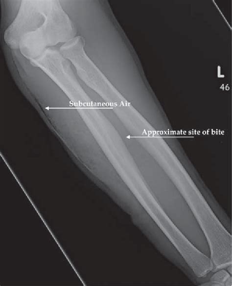 Figure 2 from Gila monster bite. | Semantic Scholar