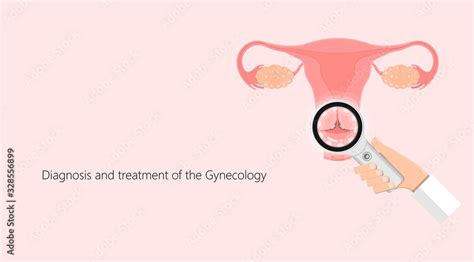 Cold knife cone biopsy Loop Electrosurgical Excision Procedure LEEP Large Loop Excision of the ...