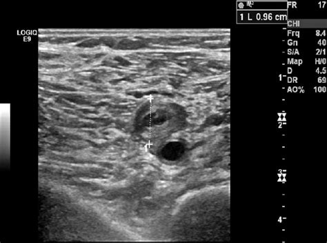 Venous Duplex Ultrasound of the Lower Extremity in the Diagnosis of ...