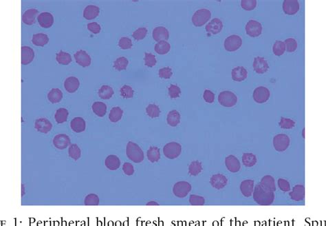 Figure 1 from Plasmapheresis for Spur Cell Anemia in a Patient with ...