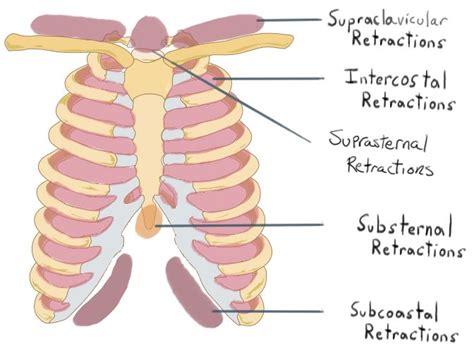 Image result for respiratory retraction | Pediatric nursing, Emergency nursing, Respiratory care