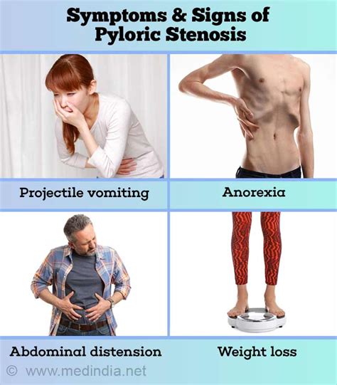 Symptoms and Signs of Pyloric Stenosis in Adults