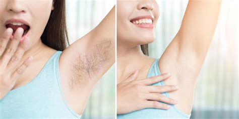 Is it possible to remove armpit hair permanently? | Vinmec