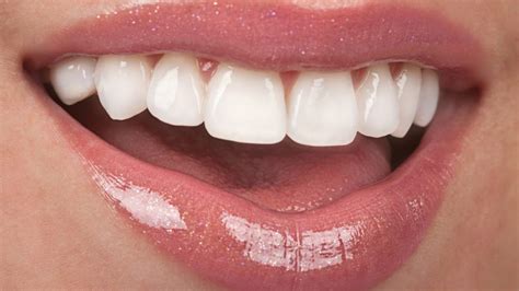 E-Max Veneers Turkey - turcountry.com