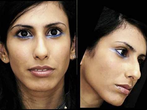 Nose Surgery - Sadove Cosmetic Surgery