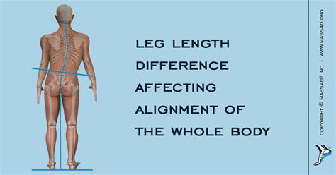 What Is Leg Length Discrepancy (LLD)? | MASS4D® Insoles - MASS4D® Foot ...